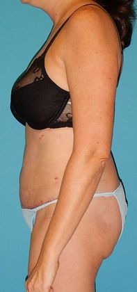 After Image: Abdominoplasty: Case 19 - left-side