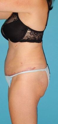 After Image: Abdominoplasty: Case 19 - left-side