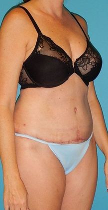 After Image: Abdominoplasty: Case 19 - right-front-oblique
