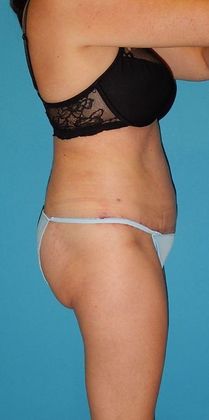 After Image: Abdominoplasty: Case 19 - right-side