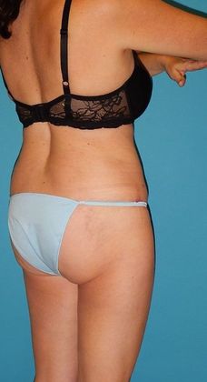 After Image: Abdominoplasty: Case 19 - right-back-oblique