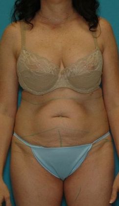 Before Image: Abdominoplasty: Case 19 - front