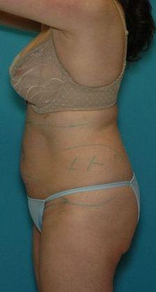 Before Image: Abdominoplasty: Case 19 - left-side