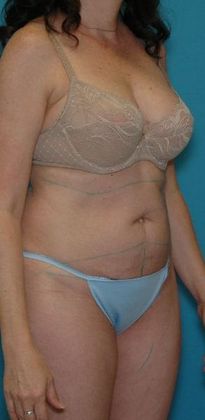 Before Image: Abdominoplasty: Case 19 - right-front-oblique