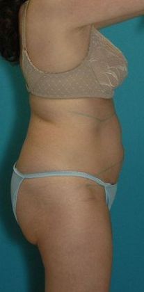 Before Image: Abdominoplasty: Case 19 - right-side