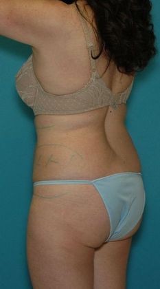 Before Image: Abdominoplasty: Case 19 - left-back-oblique
