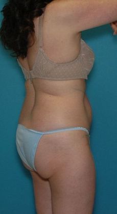 Before Image: Abdominoplasty: Case 19 - right-back-oblique
