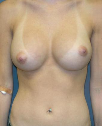 After Image: Breast Augmentation: Case2 - front