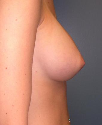 After Image: Breast Augmentation: Case2 - right-side
