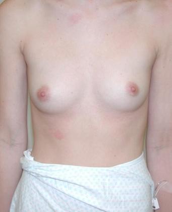 Before Image: Breast Augmentation: Case2 - front