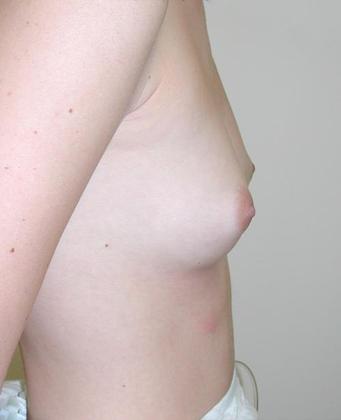 Before Image: Breast Augmentation: Case2 - right-side