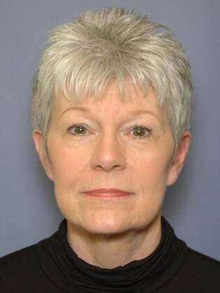 After Image: Face & Neck Lifts: Case 2 - front