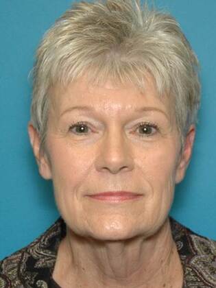 Before Image: Face & Neck Lifts: Case 2 - front