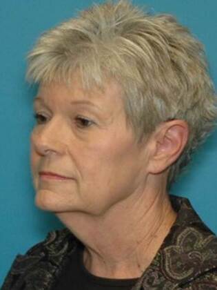 Before Image: Face & Neck Lifts: Case 2 - left-front-oblique