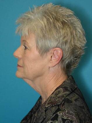 Before Image: Face & Neck Lifts: Case 2 - left-side