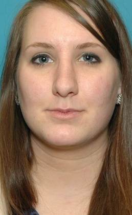 After Image: Rhinoplasty: Case 2 - front