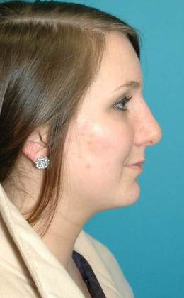 After Image: Rhinoplasty: Case 2 - right-side