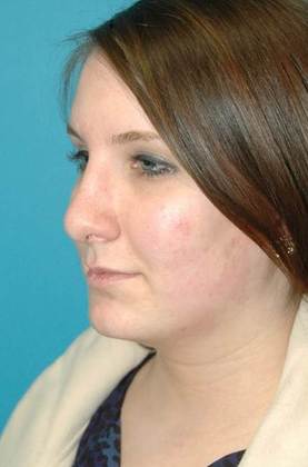 After Image: Rhinoplasty: Case 2 - left-front-oblique