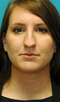 Before Image: Rhinoplasty: Case 2 - front
