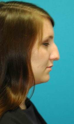 Before Image: Rhinoplasty: Case 2 - right-side