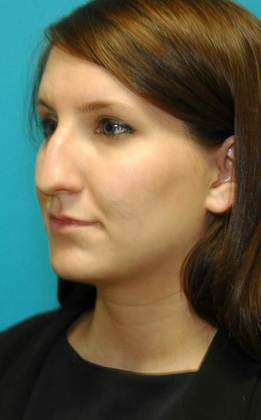 Before Image: Rhinoplasty: Case 2 - left-front-oblique