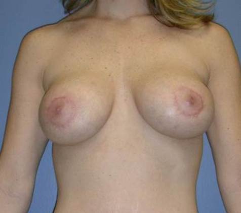 After Image: Breast Lift Augmentation: Case 2 - front