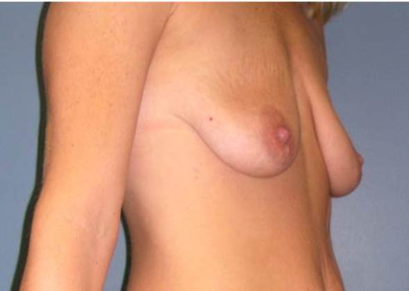 Before Image: Breast Lift Augmentation: Case 2 - right-front-oblique