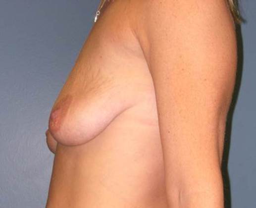 Before Image: Breast Lift Augmentation: Case 2 - left-side