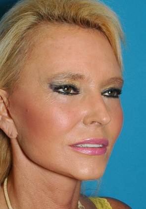 After Image: Mini Facelift: Case 2 - right-front-oblique
