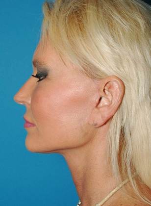 After Image: Mini Facelift: Case 2 - left-side