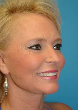 Before Image: Mini Facelift: Case 2 - right-front-oblique