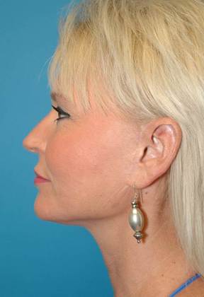 Before Image: Mini Facelift: Case 2 - left-side
