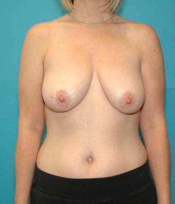 Before Image: Breast Lift: Case 2 - front