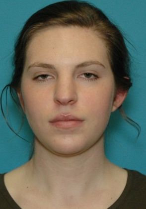 After Image: Otoplasty: Case 2 - front