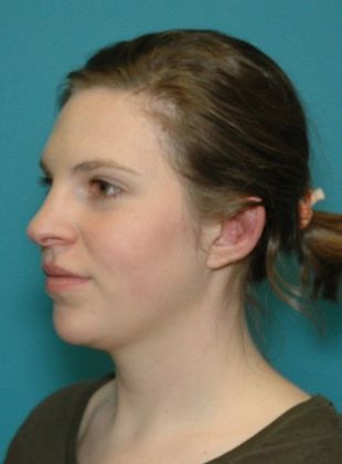 After Image: Otoplasty: Case 2 - left-front-oblique