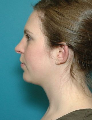 After Image: Otoplasty: Case 2 - left-side