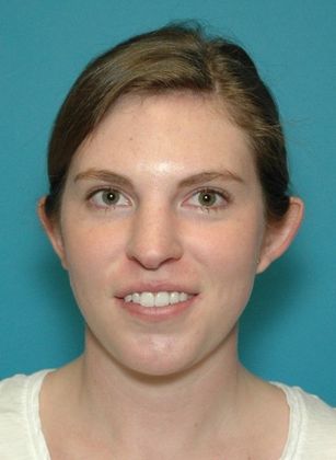 Before Image: Otoplasty: Case 2 - front