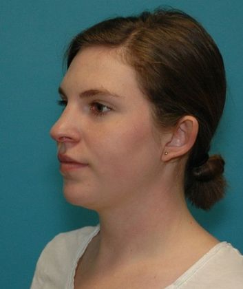 Before Image: Otoplasty: Case 2 - left-front-oblique