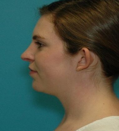 Before Image: Otoplasty: Case 2 - left-side