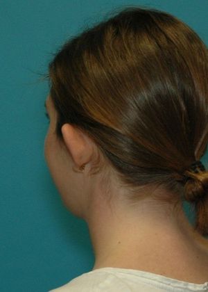 Before Image: Otoplasty: Case 2 - left-back-oblique