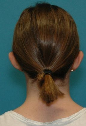 Before Image: Otoplasty: Case 2 - back