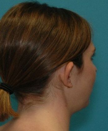 Before Image: Otoplasty: Case 2 - right-back-oblique