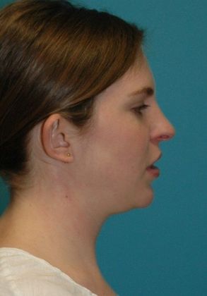 Before Image: Otoplasty: Case 2 - right-side