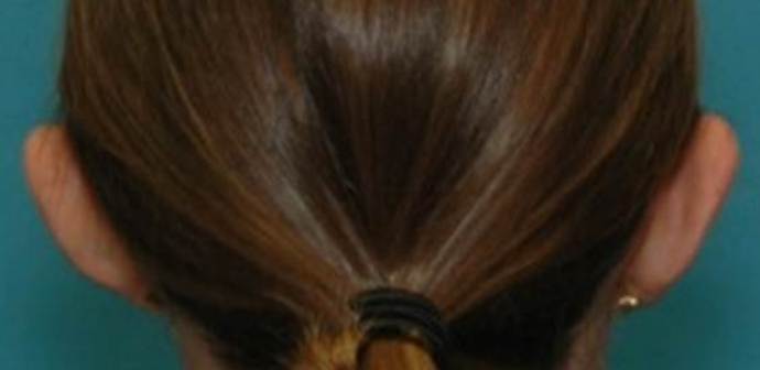 Before Image: Otoplasty: Case 2 - back