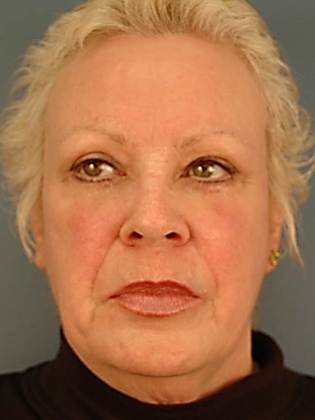 After Image: Eye Lift (Blepharoplasty): Case 2 - front