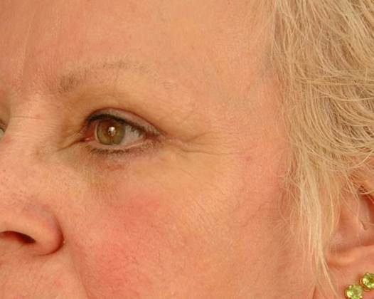 After Image: Eye Lift (Blepharoplasty): Case 2 - left-front-oblique