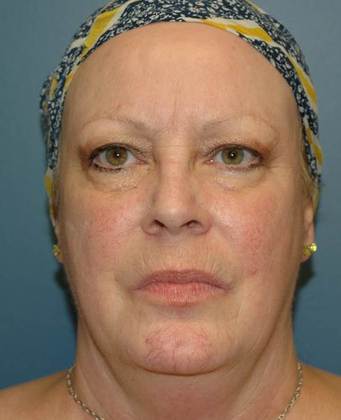Before Image: Eye Lift (Blepharoplasty): Case 2 - front