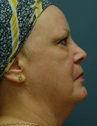 Before Image: Eye Lift (Blepharoplasty): Case 2 - right-side