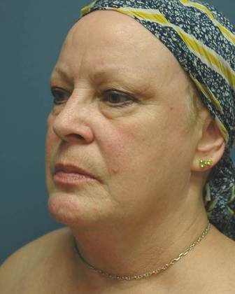 Before Image: Eye Lift (Blepharoplasty): Case 2 - left-front-oblique