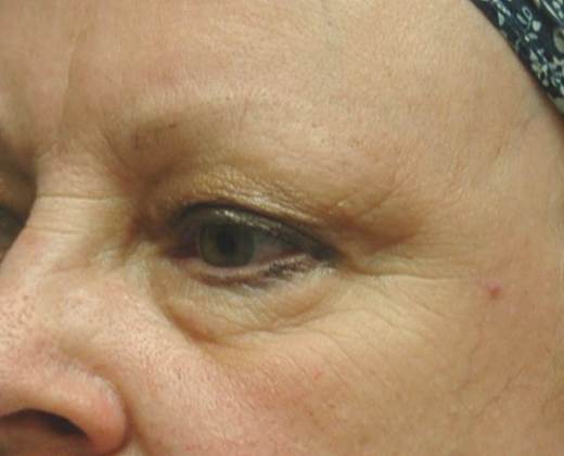 Before Image: Eye Lift (Blepharoplasty): Case 2 - left-front-oblique